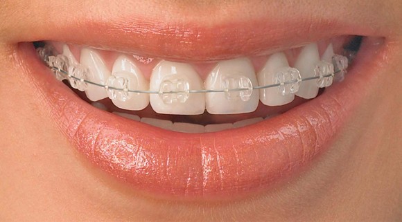EXPLORING YOUR OPTIONS: DAMON BRACES, CERAMIC BRACES, AND METAL BRACES FOR ORTHODONTIC TREATMENT 관련 이미지 2