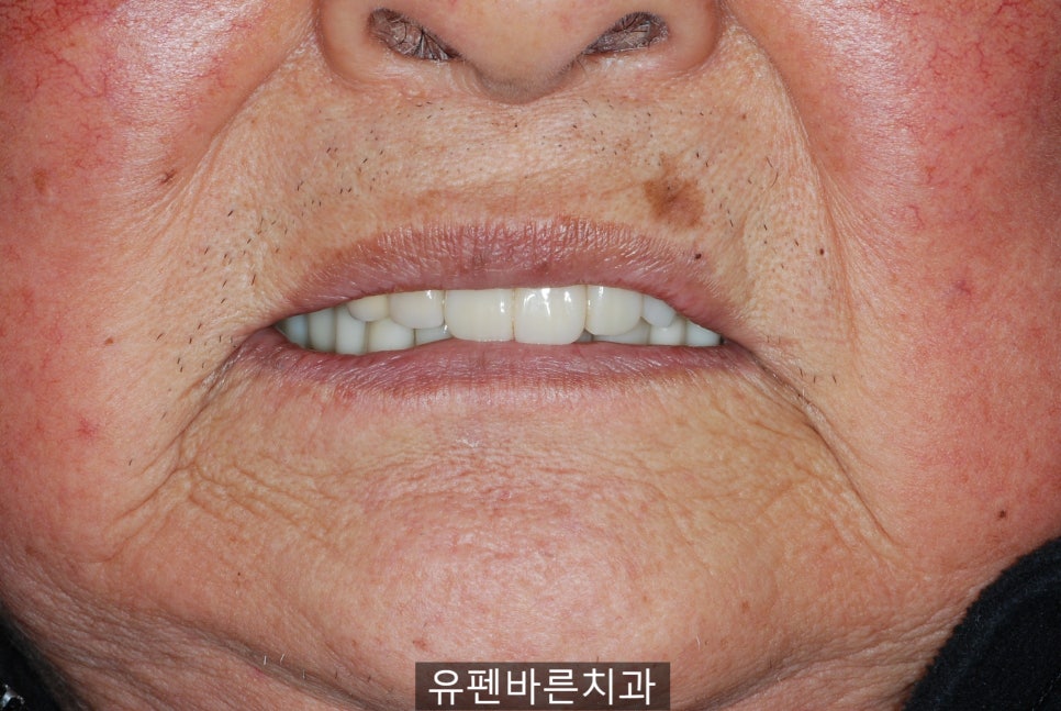 연세가 엄청 많으신데도 전체 임플란트 수술이 가능하다구요? 관련 이미지 8