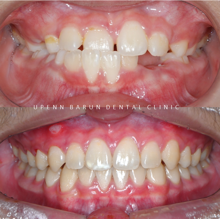 다이아몬드등급치과에서 인비절라인퍼스트로 반대교합 해결! 1차, 2차교정을 한번에!( 어린이반대교합 송파인비절라인퍼스트 잠실엘스상가교정치과 잠실인비절라인퍼스트 인비절라인스피커치과) 관련 이미지 6