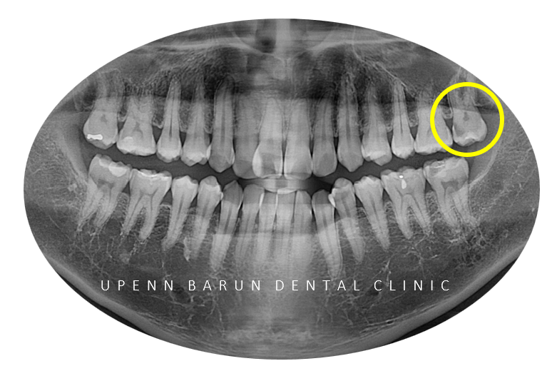 송파인비절라인다이아몬드등급 치과에서 악궁확장장치 없이 반대교합 해결한 후기(인비절라인높은등급 인비절라인반대교합 인비절라인비발치교정 인비절라인잘하는치과 인비절라인교정전문) 관련 이미지 6
