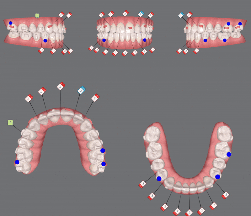 "치아가 앞으로 뻐드러졌어요!" 송파인비절라인다이아몬드등급치과에서!!(비발치인비절라인 뻐드렁니교정치과 돌출입교정치과) 관련 이미지 12