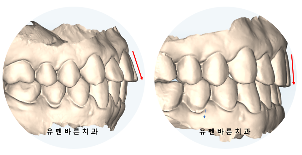 예전에 교정했는데 앞니가 뻐드러져서 컴플렉스에요! ( 비발치교정 인비절라인으로 재교정 해볼까요?) 관련 이미지 7