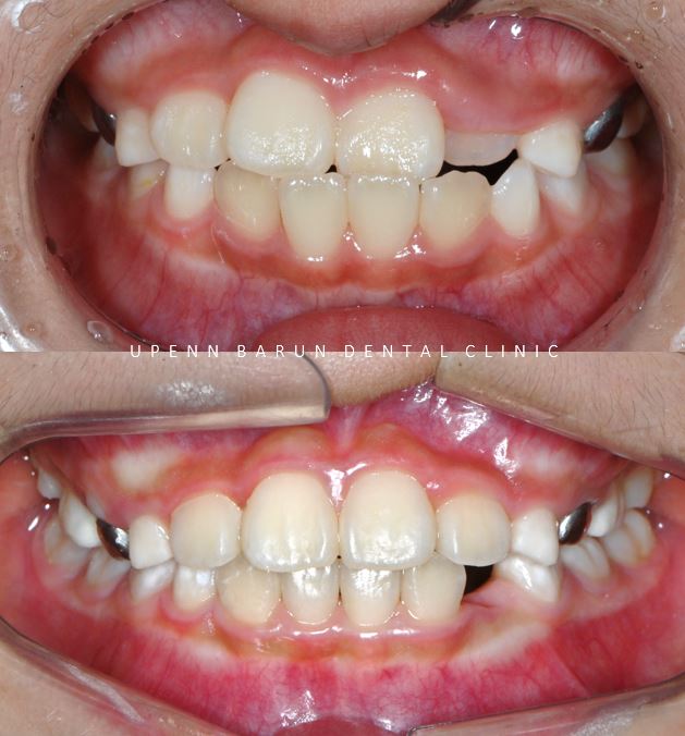 8세 어린이반대교합 인비절라인퍼스트로 수월하게 해결 후기! 잠실인비절라인퍼스트 잠실인비절라인소아교정 (잠실교정치과 잠실인비절라인 인비절라인등급 인비절라인후기 잠실소아교정) 관련 이미지 5