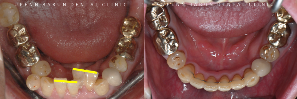 평생 삐뚤어진 치아가 고민이셨던 79세 고령환자분이 선택한 송파인비절라인다이아몬드등급 후기 (서울인비절라인전문치과 잠실인비절라인교정치과 노인교정 노인치아교정 노인교정치과) 관련 이미지 6