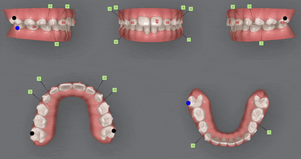 송파인비절라인퍼스트 인비절라인어린이교정 11개월만에 끝낸 후기(잠실인비절라인 잠실파인애플상가교정치과 인비절라인소아교정후기 인비절라인플래티넘엘리트등급) 관련 이미지 15