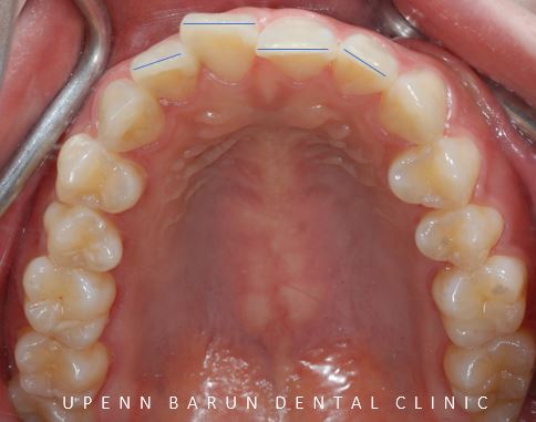 앞니부분교정 인비절라인라이트로 해결하기 (잠실인비절라인치과 송파인비절라인치과 잠실새내인비절라인치과 강동인비절라인치과 헬리오시티인비절라인 송파역인비절라인 석촌역인비절라인) 관련 이미지 7