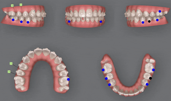 잠실소아인비절라인 잠실어린이인비절라인 송파인비절라인 잠실인비절라인후기 (잠실새내교정치과 엘스상가교정치과 파인애플상가교정치과 잠실새내역인비절라인 청소년교정후기 잠실인비절라인퍼스트) 관련 이미지 17