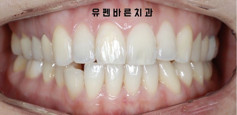 앞니부분교정 잠실인비절라인 라이트 옵션 들어보셨나요? 관련 이미지 2