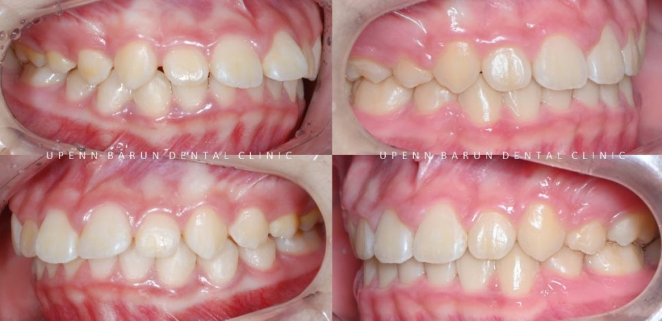 잠실새내역청소년교정 잠실돌출입발치교정은 유펜바른치과!(잠실중학생발치교정 잠실무턱교정 잠실새내소아교정치과 잠실새내교정잘하는치과 발치교정외모변화) 관련 이미지 7