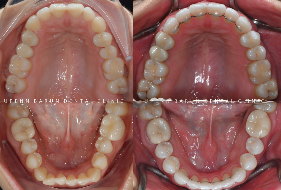 잇몸웃음 거미스마일(gummy smile) 교정후 입동굴 예쁜미소로!(잠실교정치과 거미스마일교정후기 거미스마일교정전후 클라리티세라믹교정 미니스크류교정 미국치과교정과전문의) 관련 이미지 10