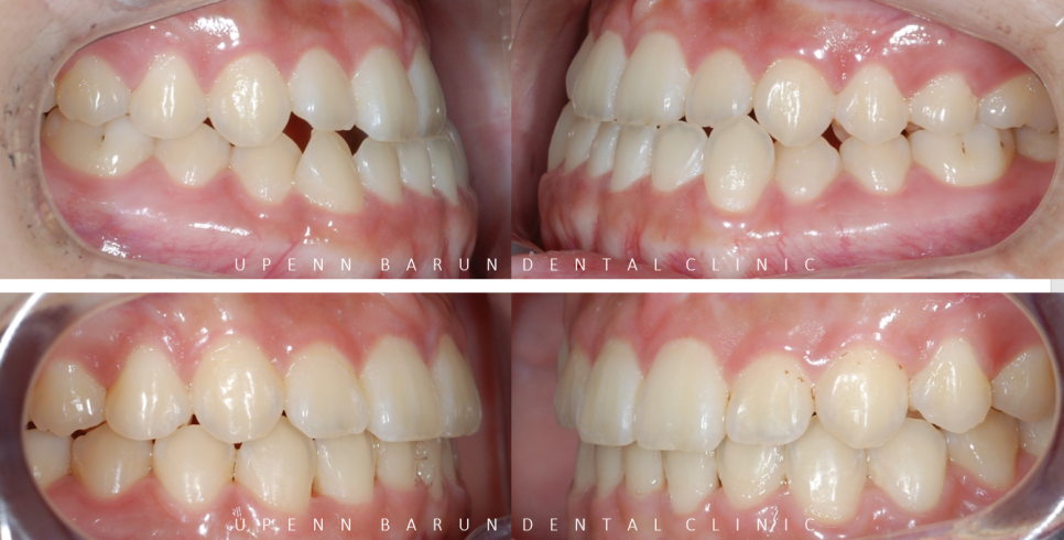 주걱턱교정, 수술교정, 양악수술도 잠실교정치과 유펜바른치과에서 관련 이미지 15
