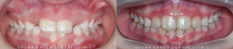 송파인비절라인퍼스트 인비절라인어린이교정 11개월만에 끝낸 후기(잠실인비절라인 잠실파인애플상가교정치과 인비절라인소아교정후기 인비절라인플래티넘엘리트등급) 관련 이미지 4