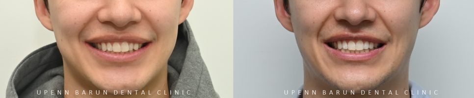 인비절라인을 시작할때 고려해야 하는 세가지 조건 (인비절라인다이아몬드 다이아몬드등급치과 인비절라인앞니교정 앞니급속교정 비발치교정 치간삭제 치간삭제양) 관련 이미지 10