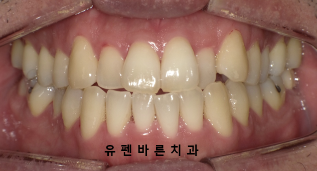 나스닥에 상장한 인비절라인, 잠실투명교정 잠실인비절라인 후기와 치아미백이 궁금하다면? 관련 이미지 2
