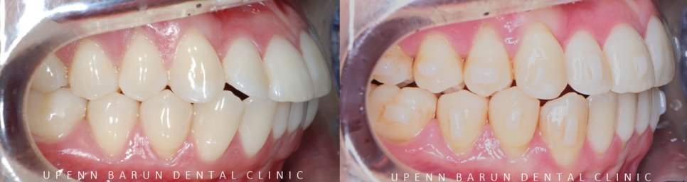 "치아가 앞으로 뻐드러졌어요!" 송파인비절라인다이아몬드등급치과에서!!(비발치인비절라인 뻐드렁니교정치과 돌출입교정치과) 관련 이미지 10