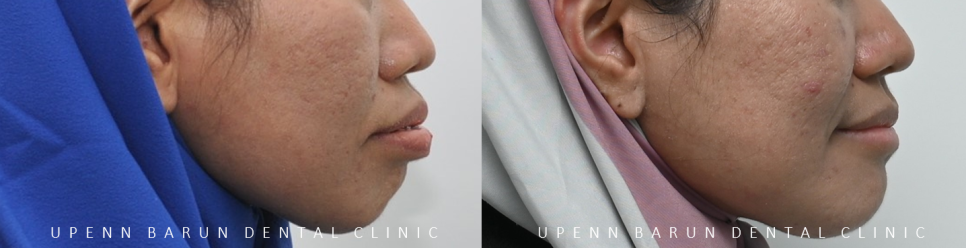 수술이 필요없는 잠실돌출입교정 잠실교정치과 입술이 잘 안다물어져 고민이라면? (돌출입전후 잠실새내교정치과 잠실발치교정 발치교정전후사진) 관련 이미지 8