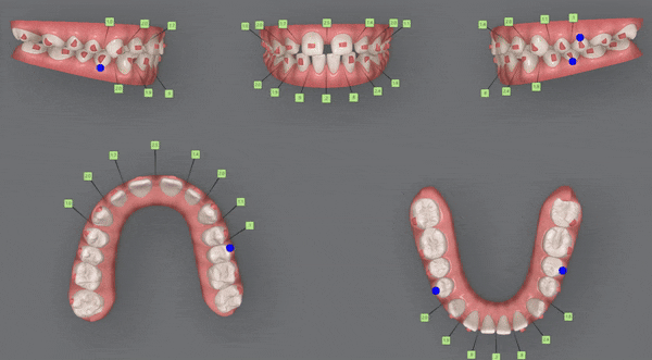 인비절라인높은등급 인비절라인플래티넘엘리트 잠실교정치과 잠실인비절라인 (잠실교정치과 송파인비절라인 인비절라인전후사진 인비절라인후기) 관련 이미지 9