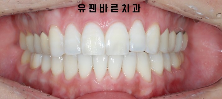 앞니부분교정 잠실인비절라인 라이트 옵션 들어보셨나요? 관련 이미지 8