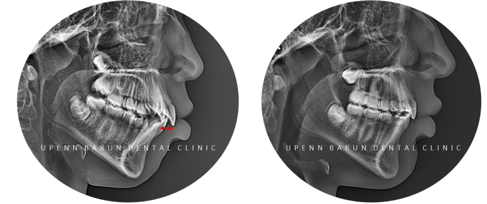 성장기에 돌출입이 고민이라면? 돌출입청소년교정 입술무력증 해결도 유펜바른치과에서! (잠실청소년교정 잠실돌출입교정 돌출입교정기간 발치교정외모변화 외국인교정치과) 관련 이미지 6