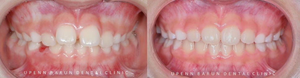 유독 튀어나와 다치기 쉬운 앞니! INVISALIGN FIRST로 8개월만에 끝낸 후기 (송파인비절라인소아교정 인비절라인1차교정 송파인비절라인퍼스트  송파인비절라인어린이교정) 관련 이미지 11