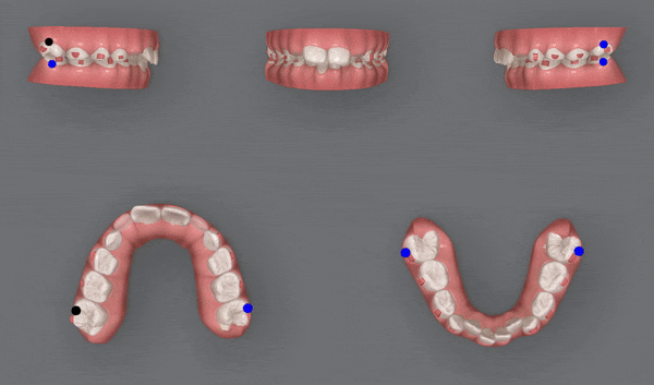 송파인비절라인퍼스트 인비절라인어린이교정 11개월만에 끝낸 후기(잠실인비절라인 잠실파인애플상가교정치과 인비절라인소아교정후기 인비절라인플래티넘엘리트등급) 관련 이미지 12
