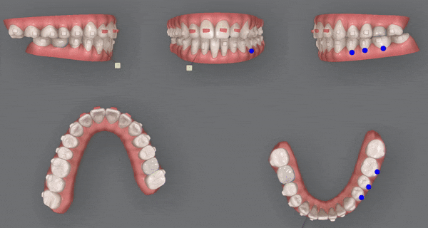 인비절라인 공식 스피커가 상주하고 치료하는 송파교정잘하는치과 유펜바른치과 (잠실성인교정 잠실재교정 잠실인비절라인 성인인비절라인교정 잠실나루역교정치과 문정동교정치과 삼전역교정치과) 관련 이미지 15