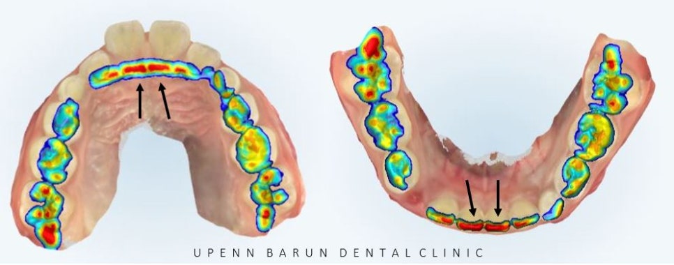유독 튀어나와 다치기 쉬운 앞니! INVISALIGN FIRST로 8개월만에 끝낸 후기 (송파인비절라인소아교정 인비절라인1차교정 송파인비절라인퍼스트  송파인비절라인어린이교정) 관련 이미지 5