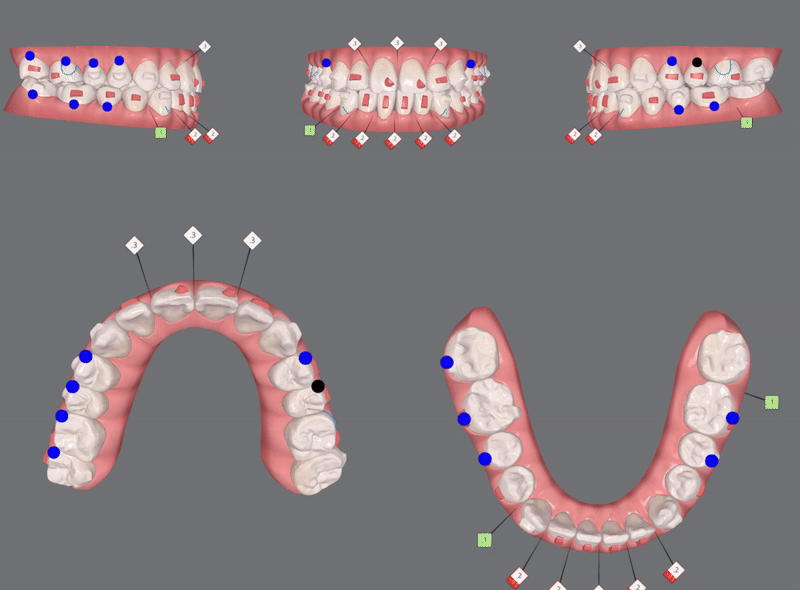 송파인비절라인다이아몬드등급 치과에서 악궁확장장치 없이 반대교합 해결한 후기(인비절라인높은등급 인비절라인반대교합 인비절라인비발치교정 인비절라인잘하는치과 인비절라인교정전문) 관련 이미지 12