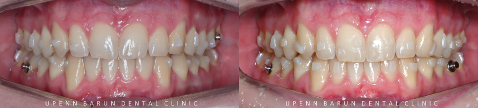 '옥니같이 보여요' 인비절라인급속교정 가능할까? with 캐리에모션장치 (잠실다이아몬드등급 인비절라인다이아몬드등급 서울다이아몬드등급치과 옥니인비절라인후기) 관련 이미지 13