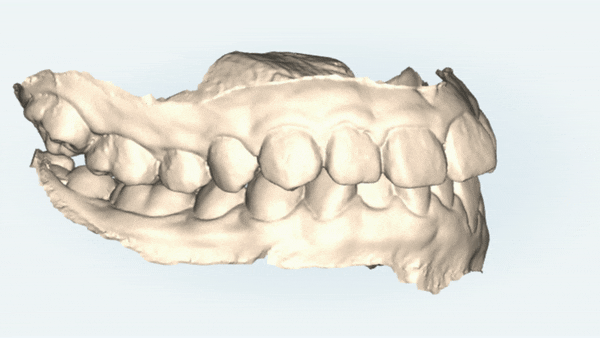 '웃을때 입을 자꾸 가려요'  활짝 웃은 중학생 비발치 인비절라인후기 (잠실새내인비절라인 청소년인비절라인 잠실교정치과) 관련 이미지 3