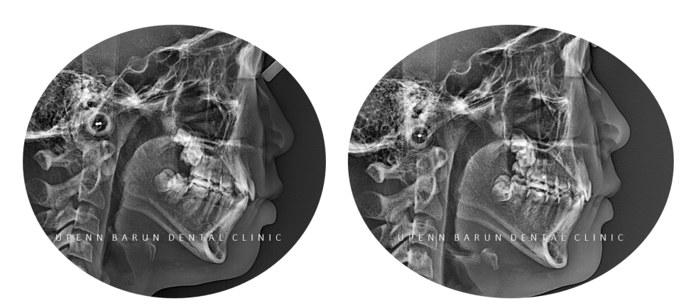 2024년 송파구 단일 치과의원급 중 유일!!! 인비절라인다이아몬드등급 달성한 유펜바른치과의 청소년인비절라인 후기 (청소년반대교합 어린이반대교합 잠실인비절라인잘하는치과) 관련 이미지 3