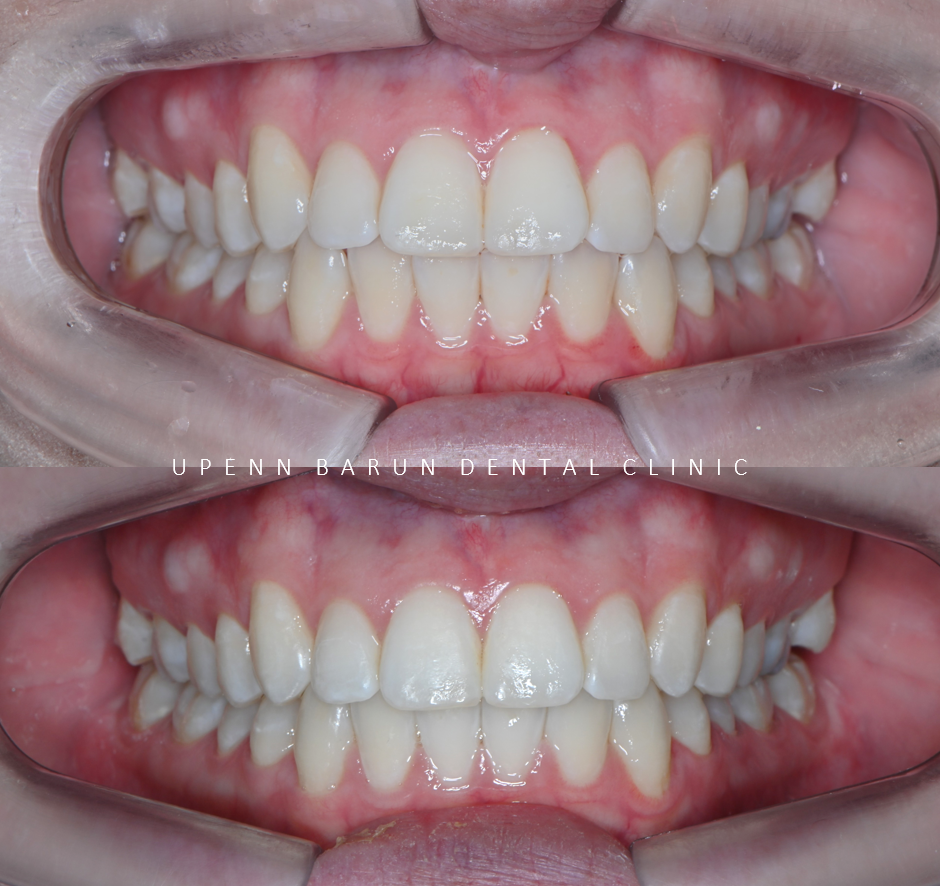 가지런했던 앞니가 삐뚤빼뚤해졌어요! 잠실다이아몬드등급 잠실인비절라인 인비절라인익스프레스 앞니 삐뚤어짐 해결(앞니급속교정 앞니투명교정 인비절라인급속교정 인비절라인전후사진) 관련 이미지 3