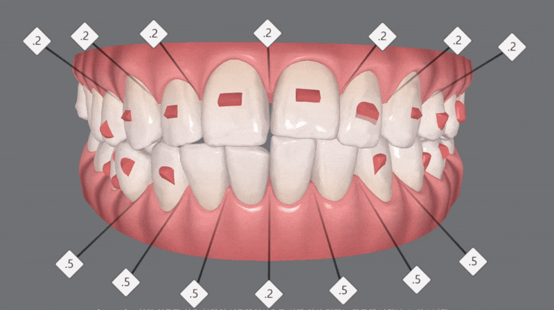 인비절라인으로 재교정, 가능할까용?? 관련 이미지 6
