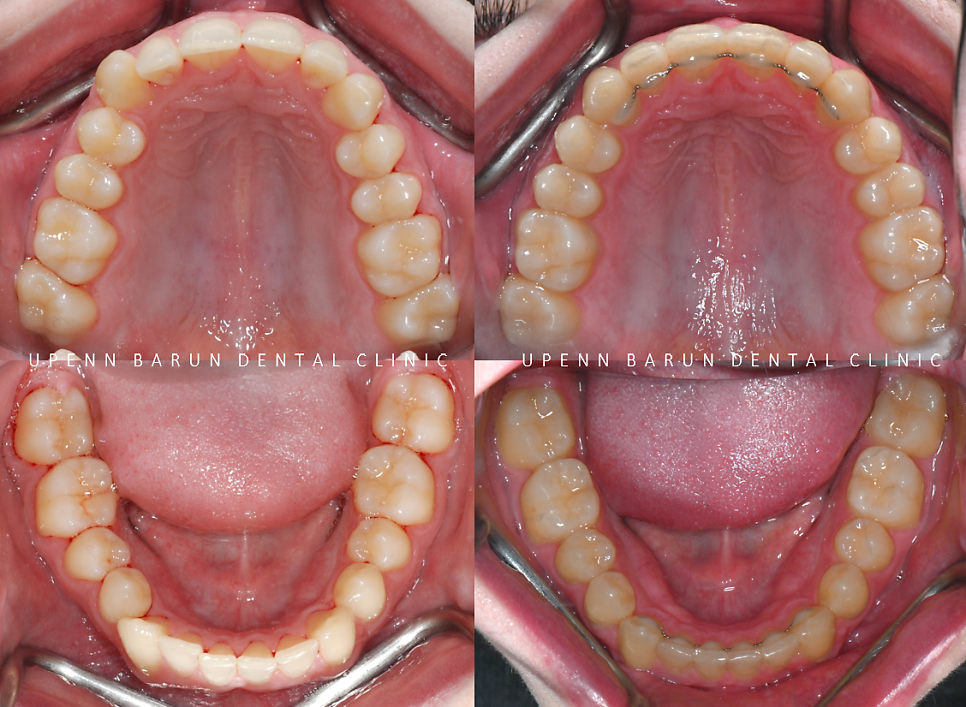 '옥니같이 보여요' 인비절라인급속교정 가능할까? with 캐리에모션장치 (잠실다이아몬드등급 인비절라인다이아몬드등급 서울다이아몬드등급치과 옥니인비절라인후기) 관련 이미지 18