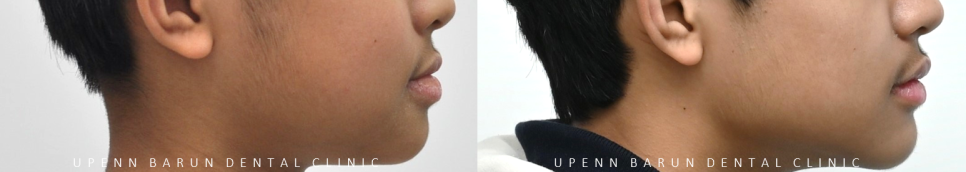 다이아몬드등급치과에서 인비절라인퍼스트로 반대교합 해결! 1차, 2차교정을 한번에!( 어린이반대교합 송파인비절라인퍼스트 잠실엘스상가교정치과 잠실인비절라인퍼스트 인비절라인스피커치과) 관련 이미지 9