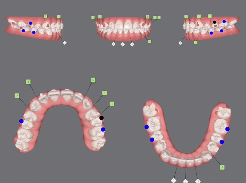 다이아몬드등급치과에서 인비절라인퍼스트로 반대교합 해결! 1차, 2차교정을 한번에!( 어린이반대교합 송파인비절라인퍼스트 잠실엘스상가교정치과 잠실인비절라인퍼스트 인비절라인스피커치과) 관련 이미지 17