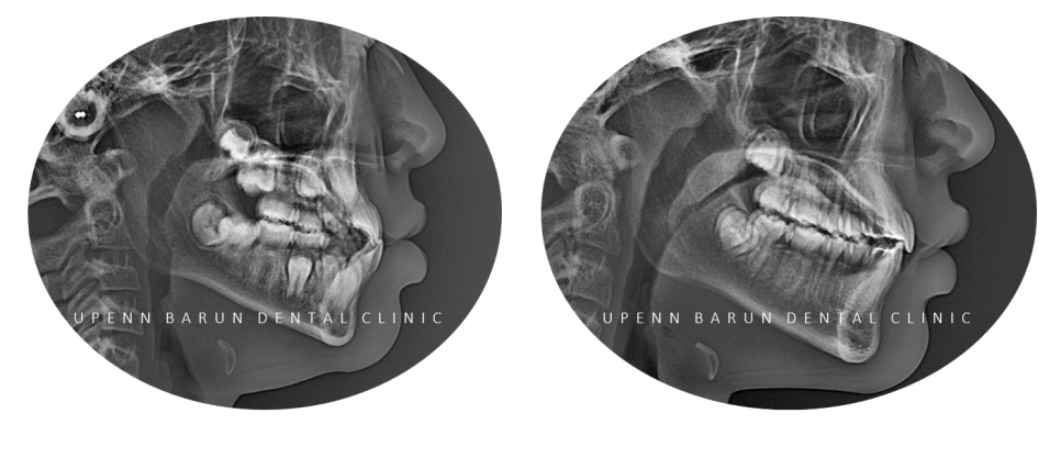 다이아몬드등급치과에서 인비절라인퍼스트로 반대교합 해결! 1차, 2차교정을 한번에!( 어린이반대교합 송파인비절라인퍼스트 잠실엘스상가교정치과 잠실인비절라인퍼스트 인비절라인스피커치과) 관련 이미지 8