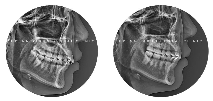앞니부분교정 인비절라인라이트로 해결하기 (잠실인비절라인치과 송파인비절라인치과 잠실새내인비절라인치과 강동인비절라인치과 헬리오시티인비절라인 송파역인비절라인 석촌역인비절라인) 관련 이미지 17