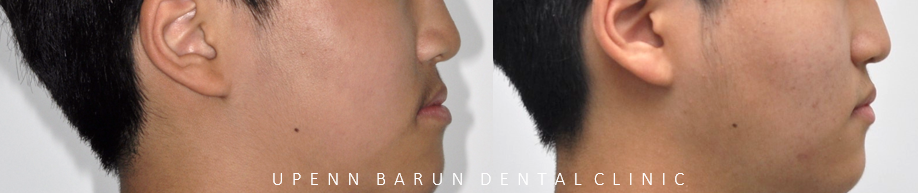 비발치교정 성장기교정 청소년치아교정은 잠실교정치과 유펜바른치과에서 관련 이미지 12