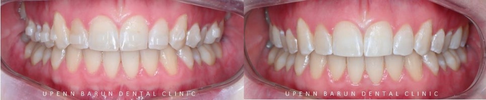 잠실교정치과 유펜바른치과의 인비절라인익스프레스가 특별한 이유 (5개월 인비절라인급속교정 잠실인비절라인 송파인비절라인 인비절라앞니부분교정) 관련 이미지 12