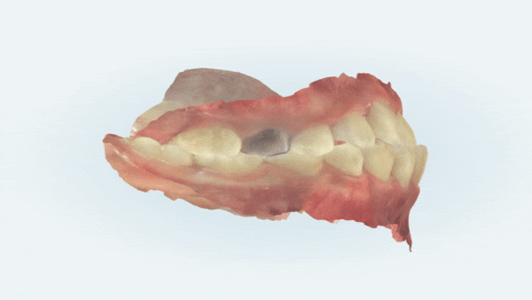 8세 어린이반대교합 인비절라인퍼스트로 수월하게 해결 후기! 잠실인비절라인퍼스트 잠실인비절라인소아교정 (잠실교정치과 잠실인비절라인 인비절라인등급 인비절라인후기 잠실소아교정) 관련 이미지 3