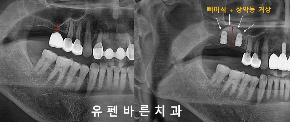 상악동 때문에 대학병원가서 임플란트 하라고 권유받으신 분들 필독!!! 관련 이미지 2