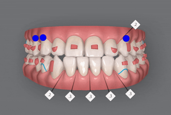 주걱턱 반대교합도 잠실인비절라인 잠실교정치과 유펜바른치과에서!(비발치주걱턱교정 잠실성인교정 반대교합인비절라인 잠실교정치과 주걱턱교정후기) 관련 이미지 13