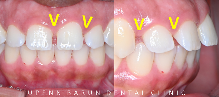 잠실인비절라인등급 잠실부분교정 앞니틈교정 인비절라인라이트 옵션으로 빠르게 해결한 후기 (삼성역부분교정 인비절라인앞니재교정 잠실역교정치과 삼전동인비절라인 삼전동교정치과) 관련 이미지 4