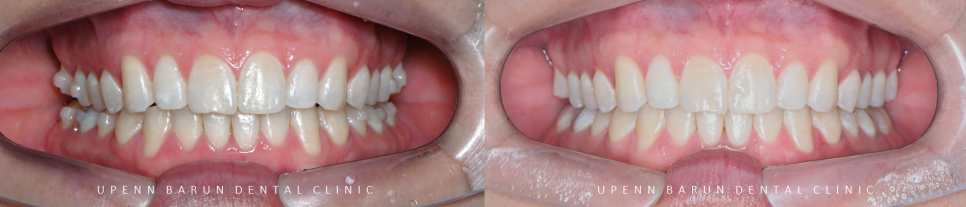 인비절라인을 시작할때 고려해야 하는 세가지 조건 (인비절라인다이아몬드 다이아몬드등급치과 인비절라인앞니교정 앞니급속교정 비발치교정 치간삭제 치간삭제양) 관련 이미지 14