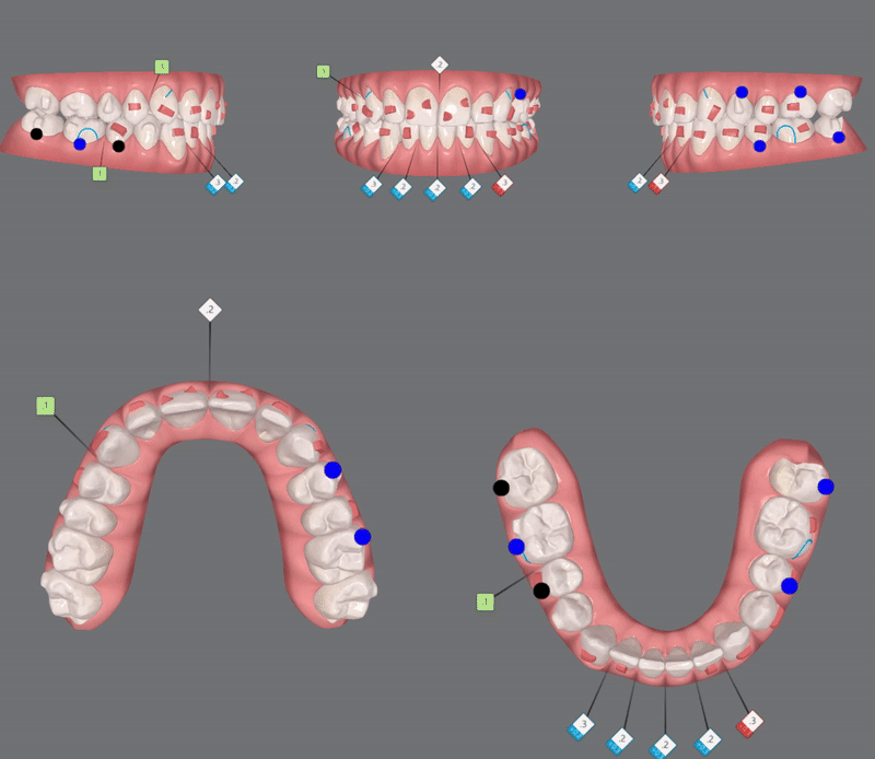 '옥니같이 보여요' 인비절라인급속교정 가능할까? with 캐리에모션장치 (잠실다이아몬드등급 인비절라인다이아몬드등급 서울다이아몬드등급치과 옥니인비절라인후기) 관련 이미지 12