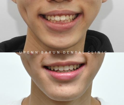 잠실청소년교정 청소년소년돌출입교정 잠실발치교정은 유펜바른치과에서! (잠실나루역교정치과 삼전역교정치과 잠실새내교정치과 돌출입전후 발치교정전후사진) 관련 이미지 15