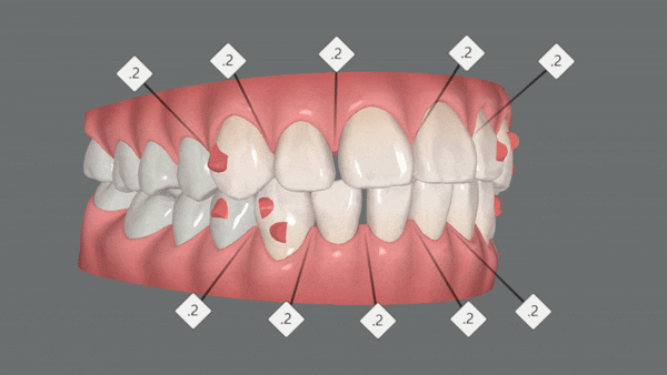 20대 여성 앞니 사이 틈 2개월만에 해결 (인비절라인익스프레스 INVISALIGN EXPRESS 인비절라인후기 잠실인비절라인  잠실투명교정치과) 관련 이미지 6