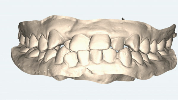 잠실데이몬교정, 비발치교정, 잠실덧니교정 (AKA Damon Smile) 관련 이미지 6
