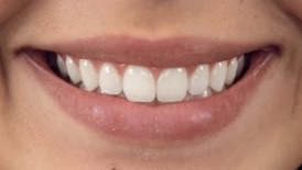 Smile Esthetics (예쁜 미소의 기준) 1편: 스마일 아크 관련 이미지 2